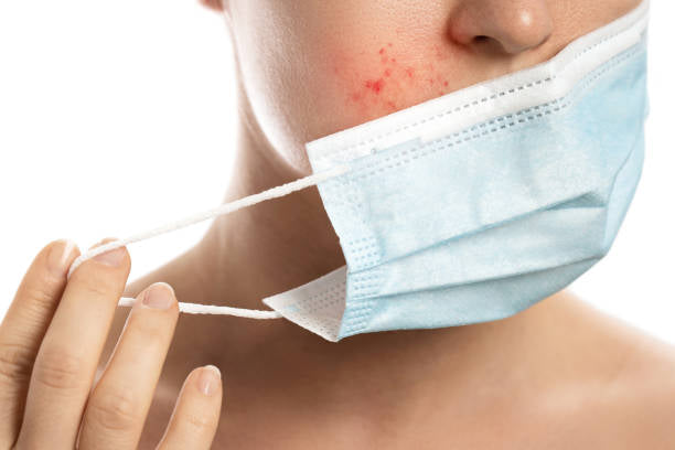 Red and oily skin with constant acne? Afraid of being troubled by the "mask muscle" problem!